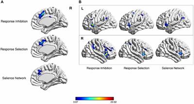 Cortico-Striatal-Thalamic Loop Circuits of the Salience Network: A Central Pathway in Psychiatric Disease and Treatment